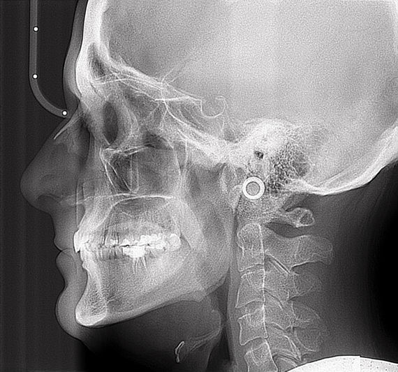 Zdjęcie cefalometryczne to zdjęcie boczne czaszki, niezbędne do zdiagnozowania wad zgryzu i zaplanowania przez lekarza leczenia u młodzieży i os