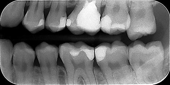 Na zdjęciu skrzydłowo-zgryzowym widoczne są powierzchnie styczne wszystkich zębów górnych i dolnych jednej strony (prawej lub lewej).